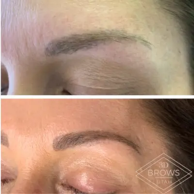Eyebrow tattoo removal
