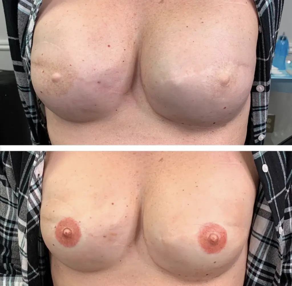 Areola restoration Salt Lake City