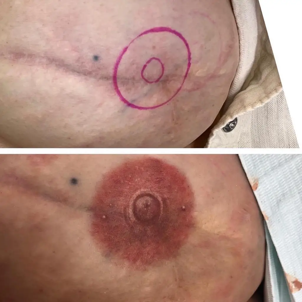 Areola tattoo restoration in Salt Lake City