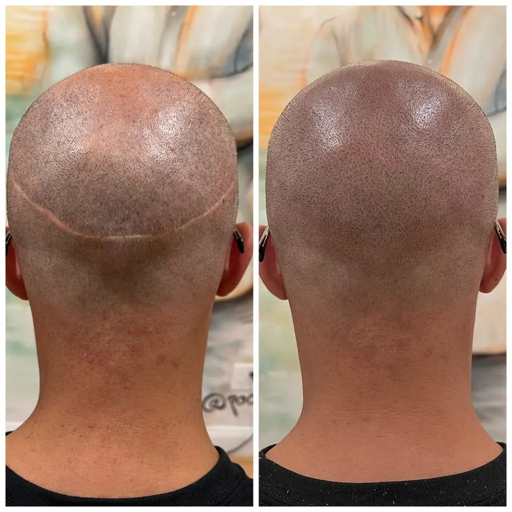 Scalp Micropigmentation Men Scalp