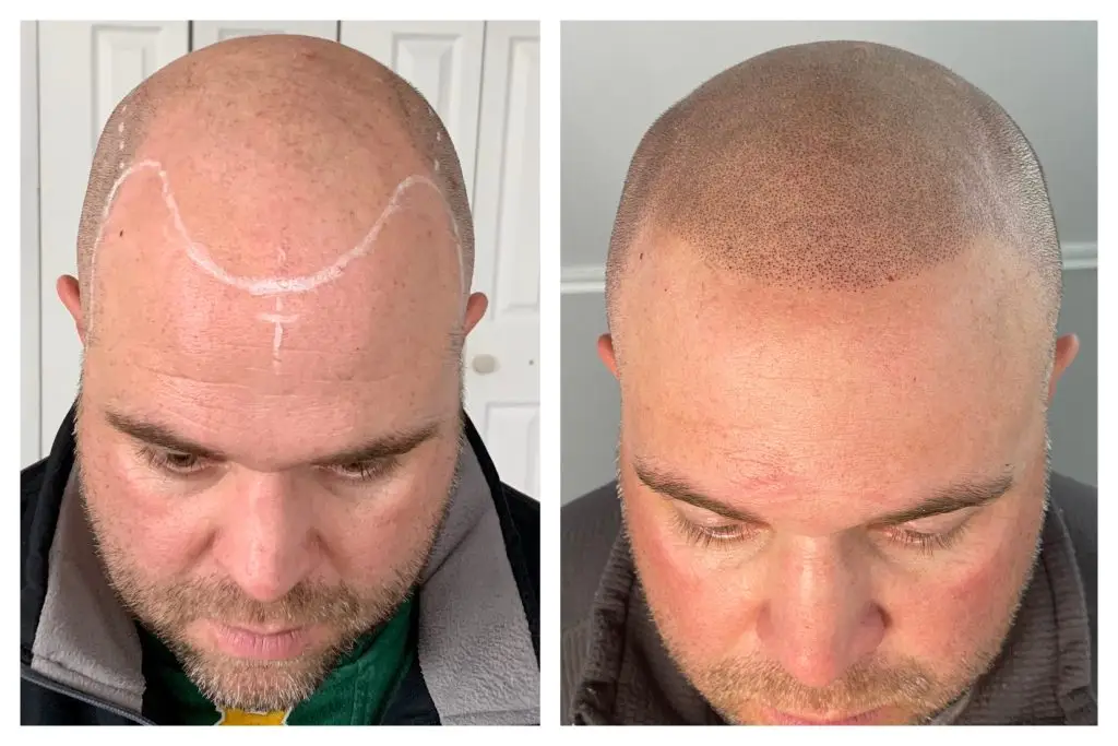 scalp micropigmentation before and after