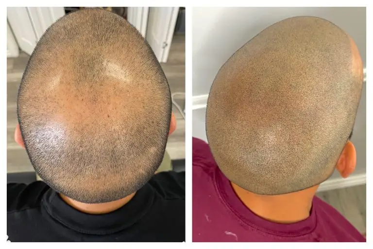 scalp pigmentation before and after