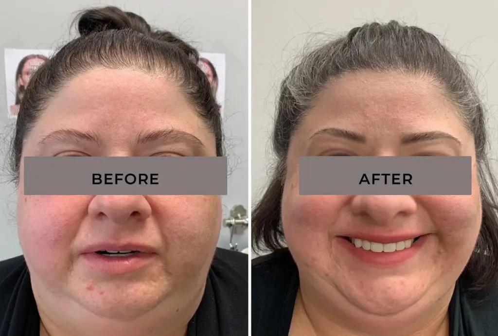 women's scalp micropigmentation