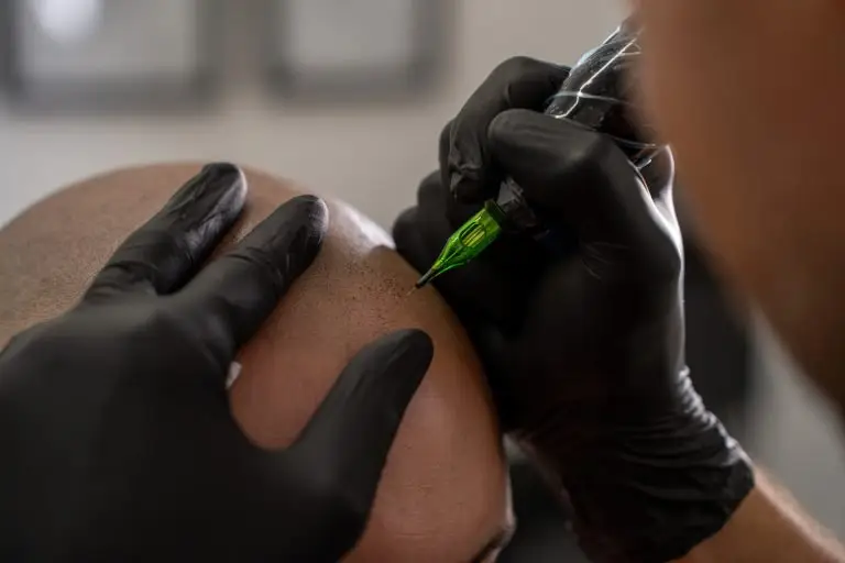 Scalp Micropigmentation